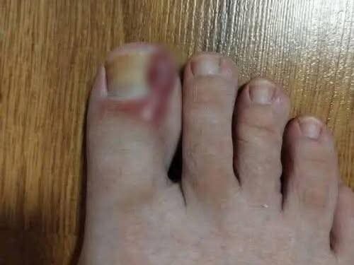 How to Treat an Ingrown Toenail at Home: Tips and Natural Remedies