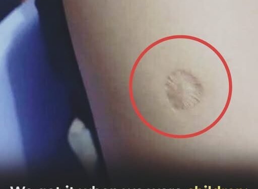 What the small round scar on your arm might indicate