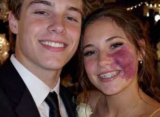 Only One Boy Asked Me to Prom Because No One Else Wanted to Due to the Birthmark on My Face – Everyone Laughed Until an Officer Walked Into the Hall