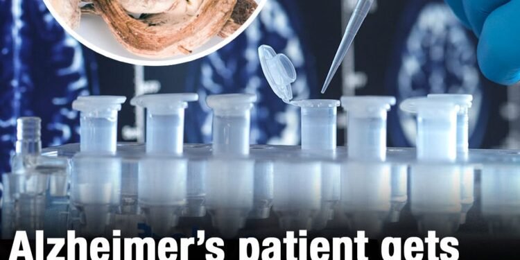 Alzheimer’s patient recovers speech and memories in groundbreaking drug trial
