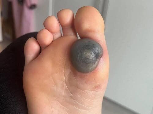 My daughter woke up with this huge spot on her foot I don’t know what it could be. She’s been in pain and can’t move her foot what is this.. Explain this