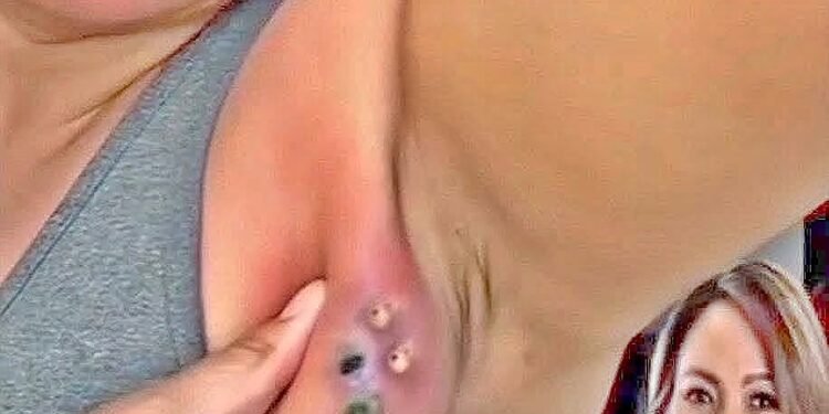 THEIR ACNE IS SEVERE!