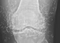 Doctors find “gold mine” in woman’s knees Newsner» News» Doctors find “gold mine” in woman’s knees