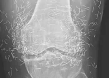 Doctors find “gold mine” in woman’s knees Newsner» News» Doctors find “gold mine” in woman’s knees