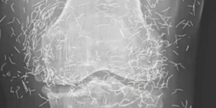Doctors find “gold mine” in woman’s knees Newsner» News» Doctors find “gold mine” in woman’s knees